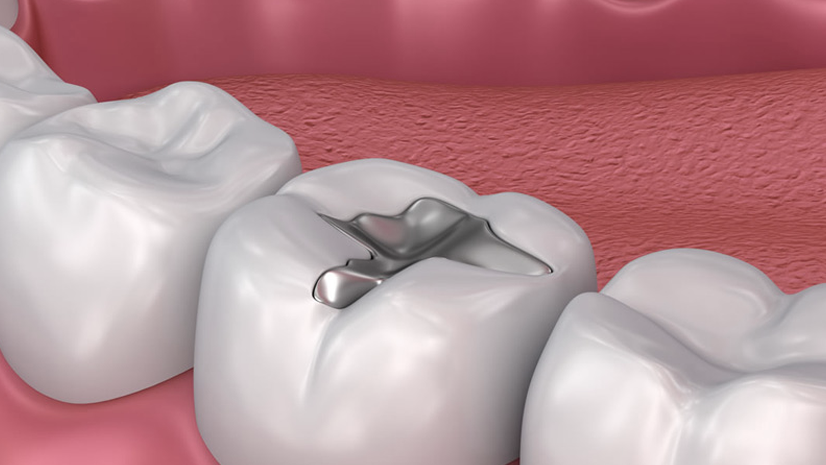 Amalgam Removal Dentist | Holistic Dental Brunswick